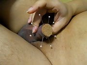 Foreskin needle 16