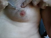 Male nipples saline injection during scrotal infusion play